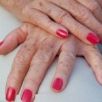 age-spots