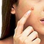 pimple-main_full