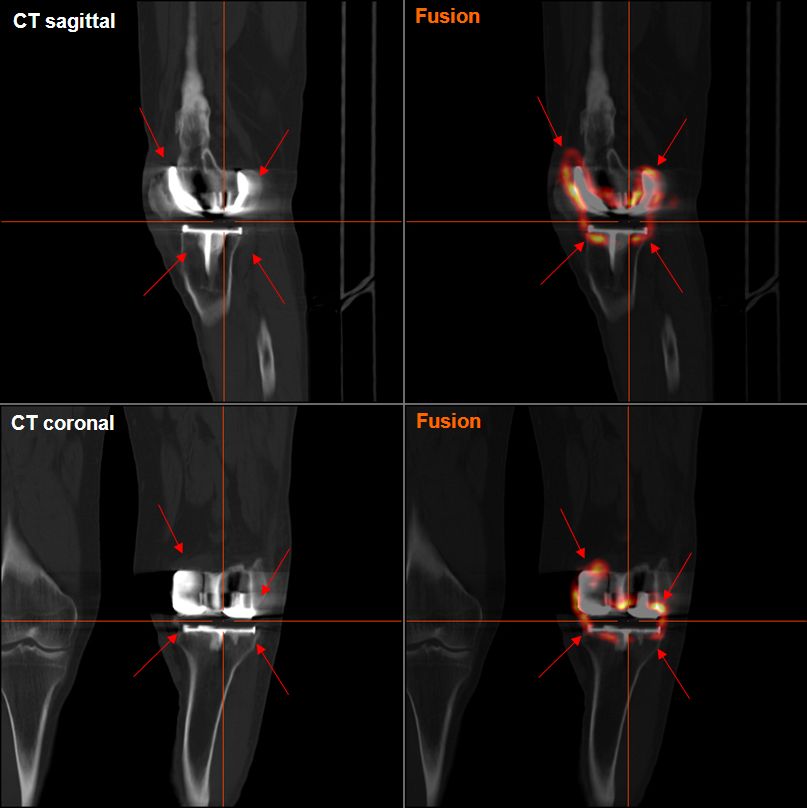Knee Replacement Knee Replacement Surgery